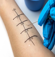 Image illustrating Skin Prick Test