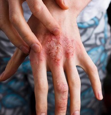 Image illustrating Atopic Dermatitis