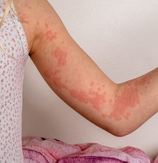 Image illustrating Urticaria/Hives